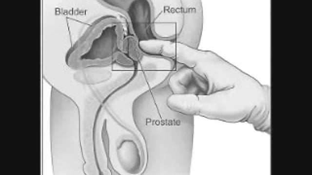 Prostate howto