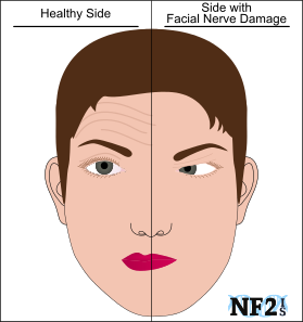 HB reccomend Damage to the right facial ne