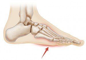 Unexplained pain bottom foot