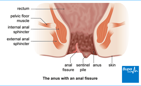 Anal fissures and relaxation