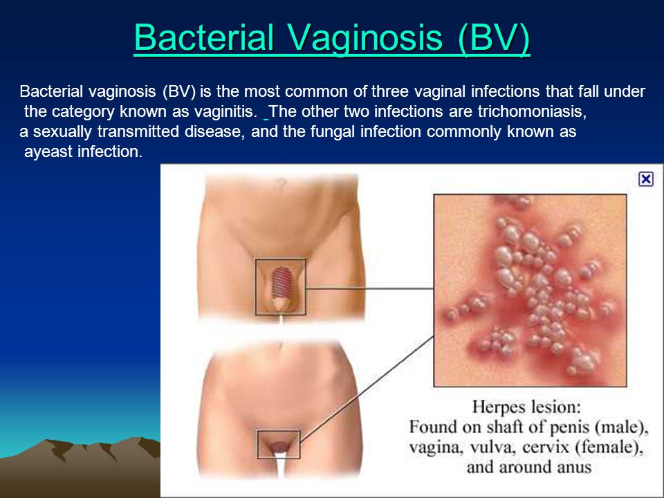 Interstate reccomend Bacterial vaginosis anal