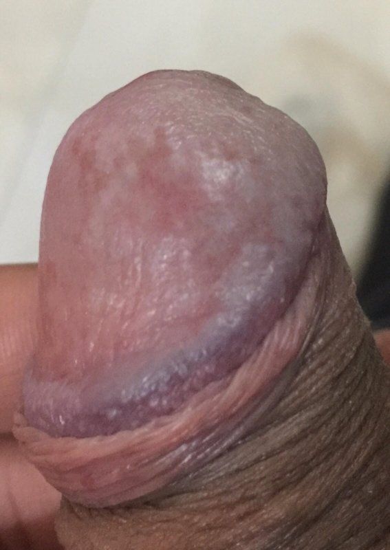 Grinch recomended head discoloration pain Penis