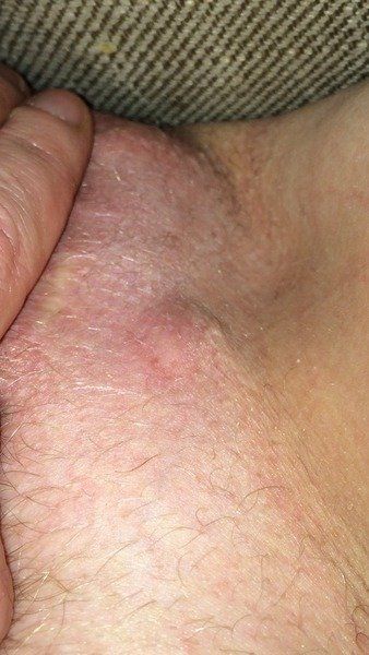 Sugar reccomend Painful blister on vulva