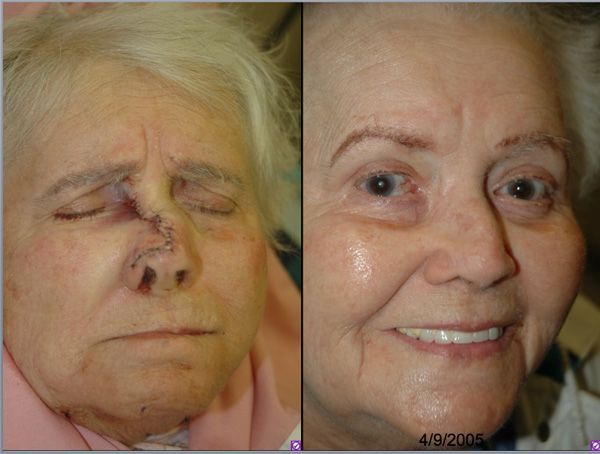 Snickerdoodle reccomend Facial scar plastic surgery