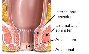 Anal spincter spasms