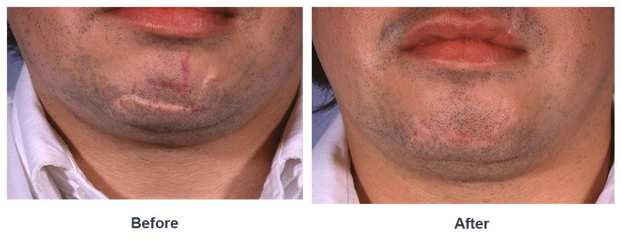 Smoke recommendet surgery plastic Facial scar