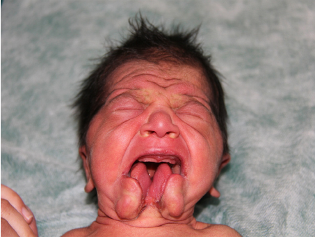 Doctor reccomend facial cleft syndrome Median