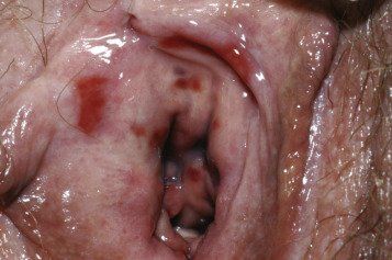 Perianal rash vulva clitoris painful