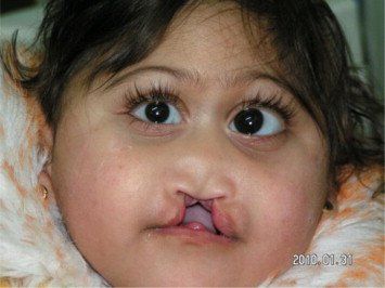 White L. reccomend Median facial cleft syndrome