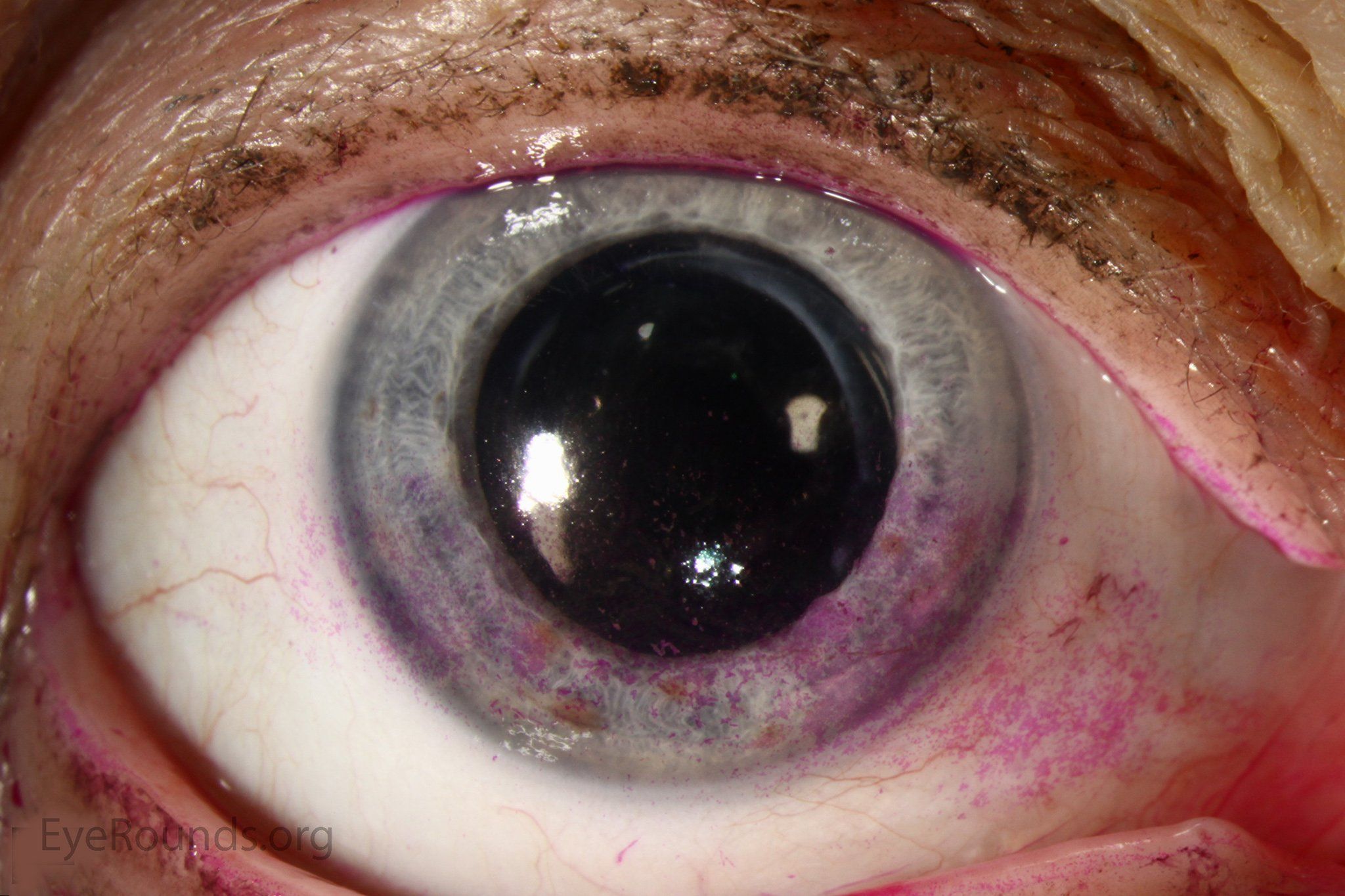 Black P. reccomend Pissing pink eye