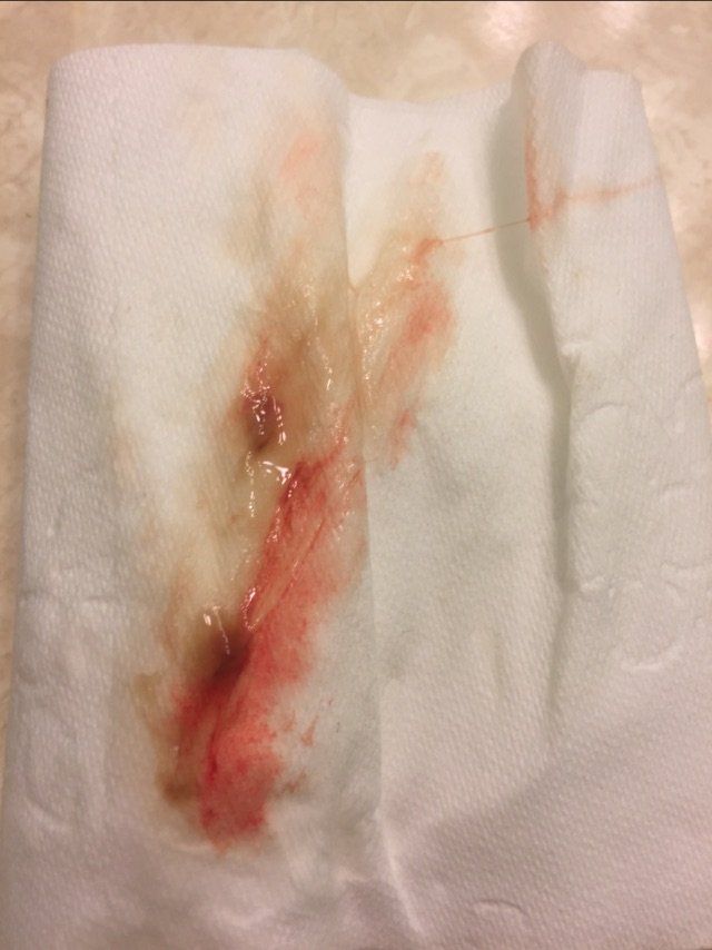 Stargazer reccomend Bleeding during masturbation