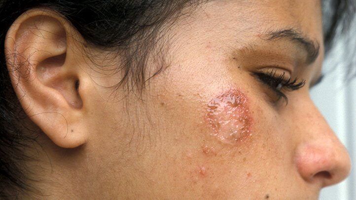 Bullet reccomend Recurrent blistering facial rashes