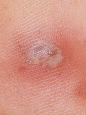 Slobber-knocker reccomend Painful blister on vulva