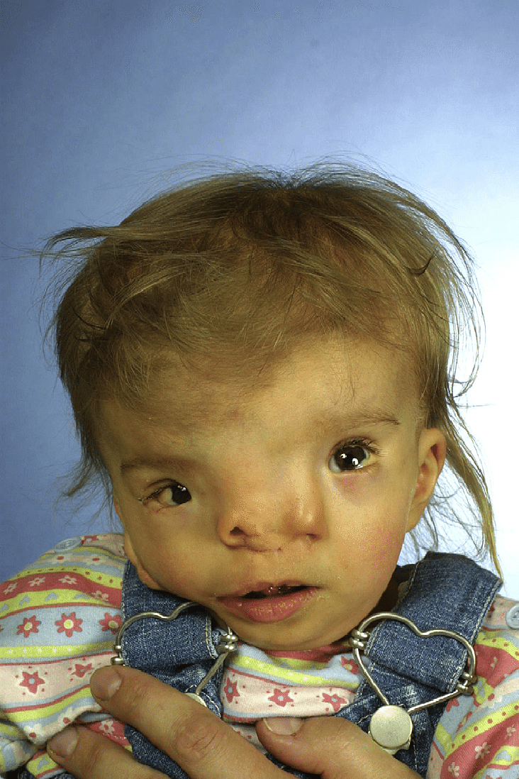 best of Facial cleft syndrome Median
