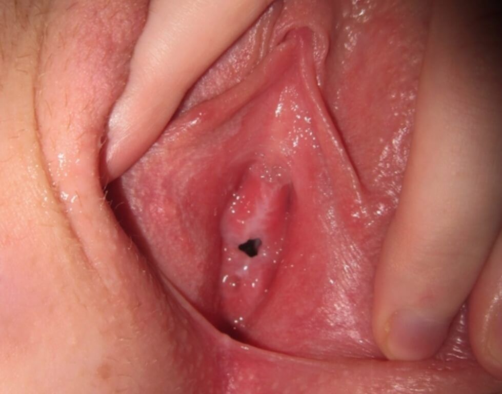 Can vagina tear from sex