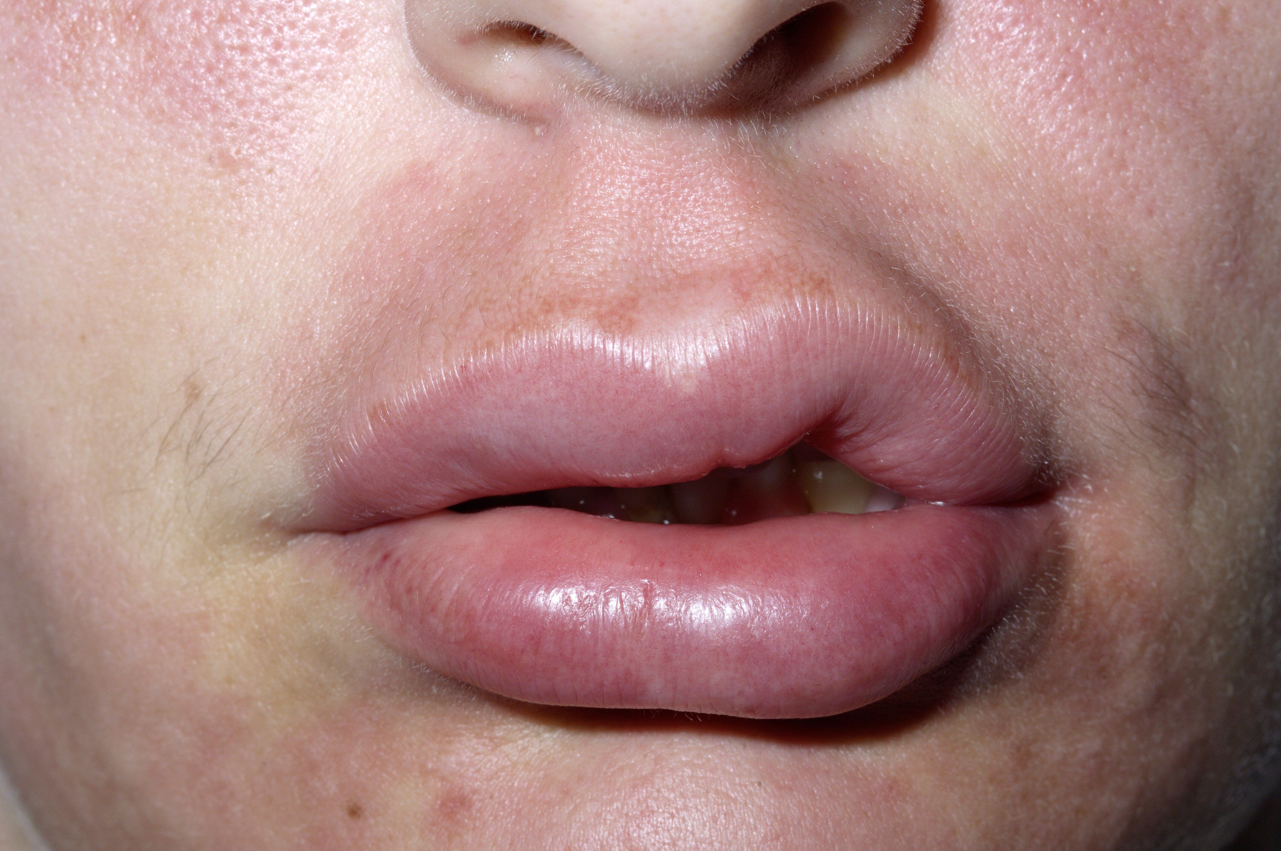 Facial swelling hives