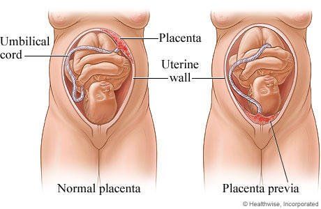Earnie reccomend Placenta previa orgasm