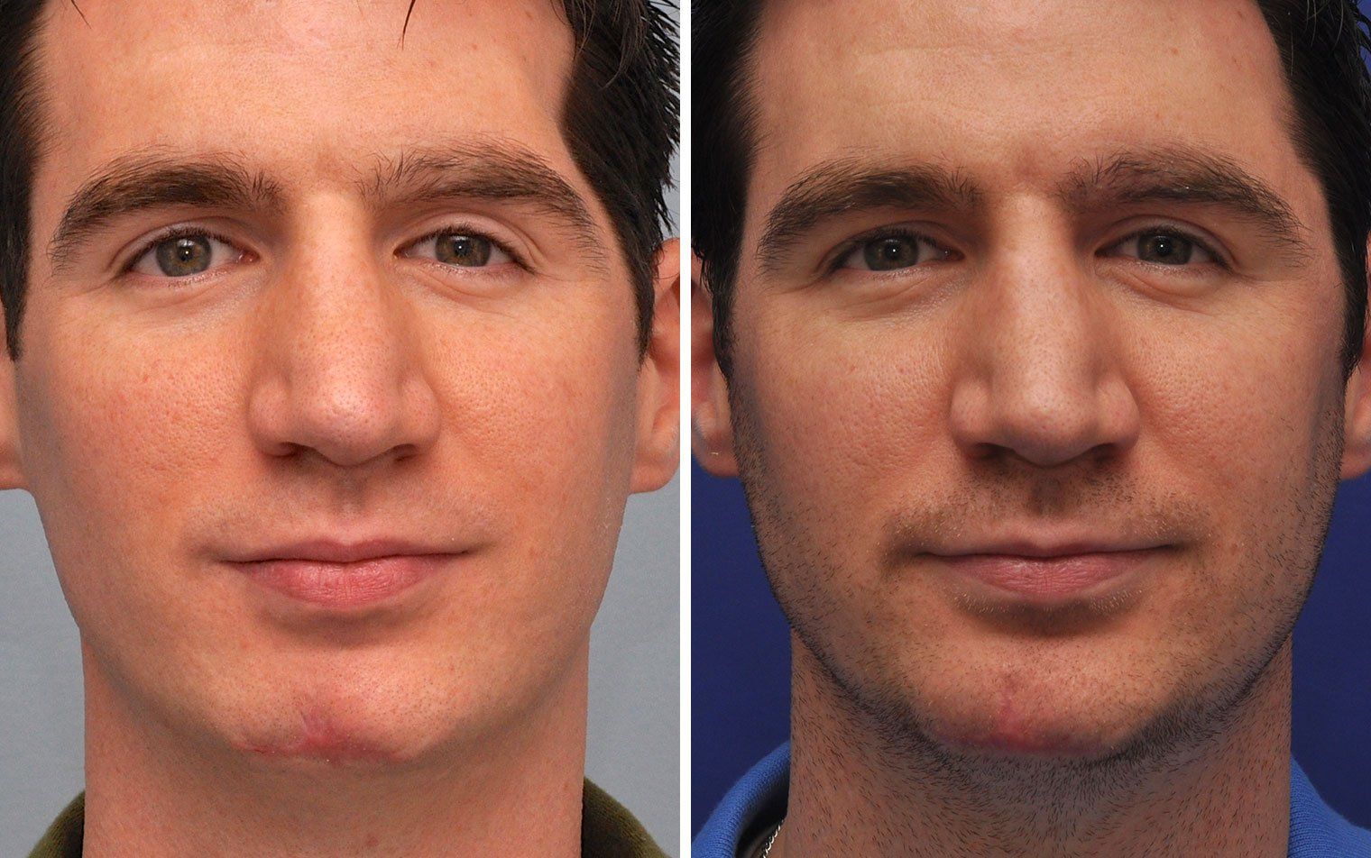 Facial scar plastic surgery