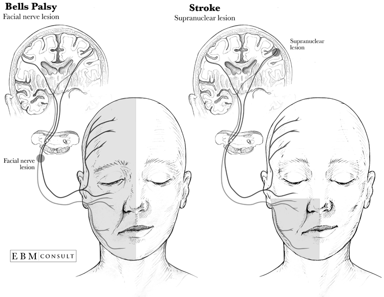 Peripheral facial nerve