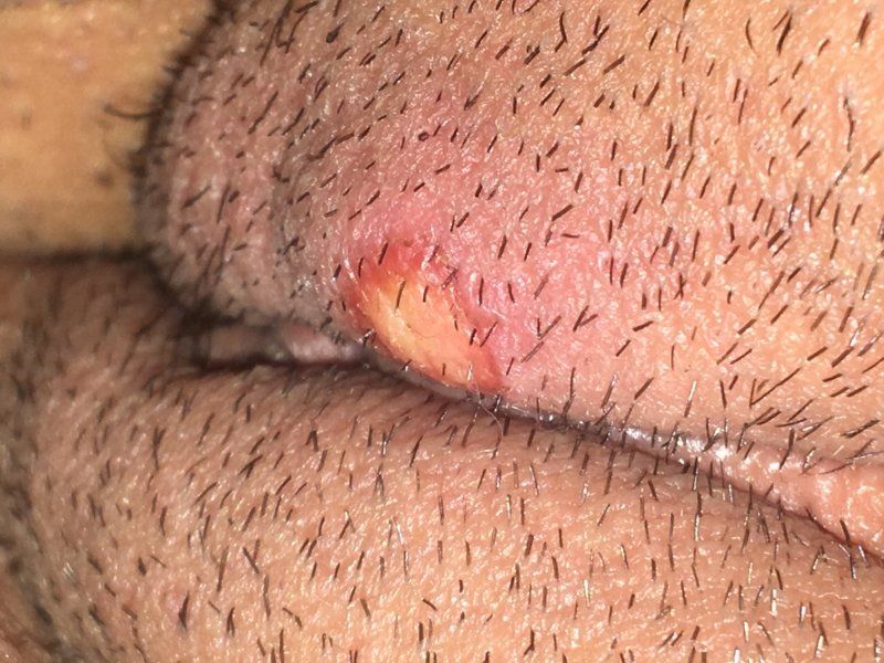 Blister near vagina