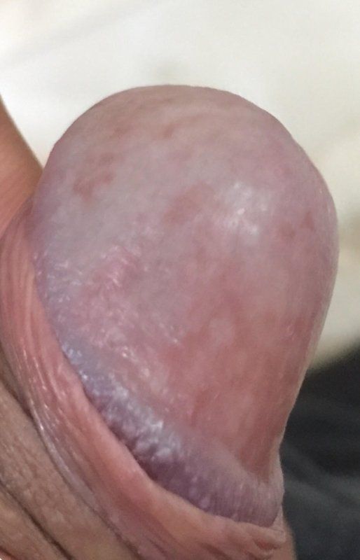 Penis head discoloration pain
