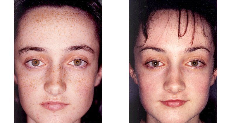 best of Peels by Skin facial caused damage