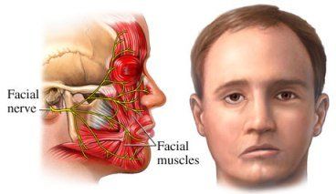 Gumby reccomend Facial nerve pain from