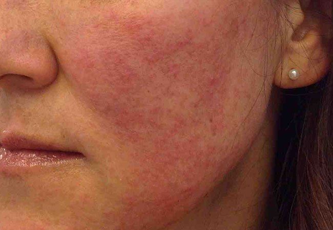 best of Facial rash for Treatment