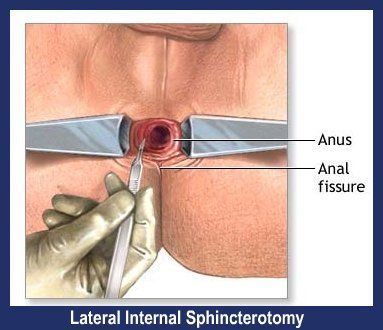 Opal reccomend Anal fisher treatment