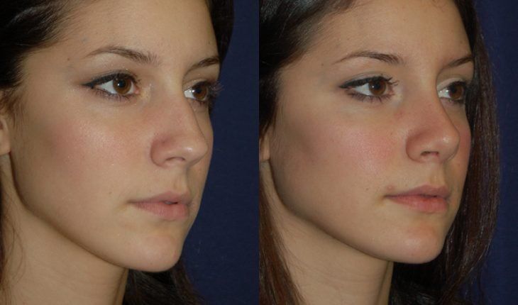 Compare facial surgery
