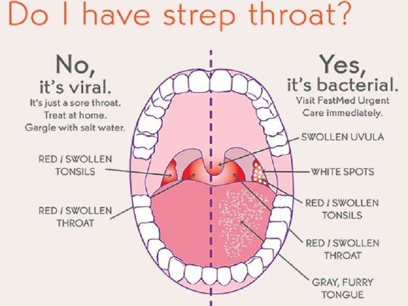Adults and strep throat