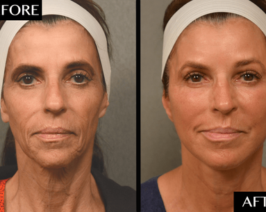 best of Facial surgery Maximal