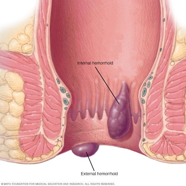 Red anus hemroids