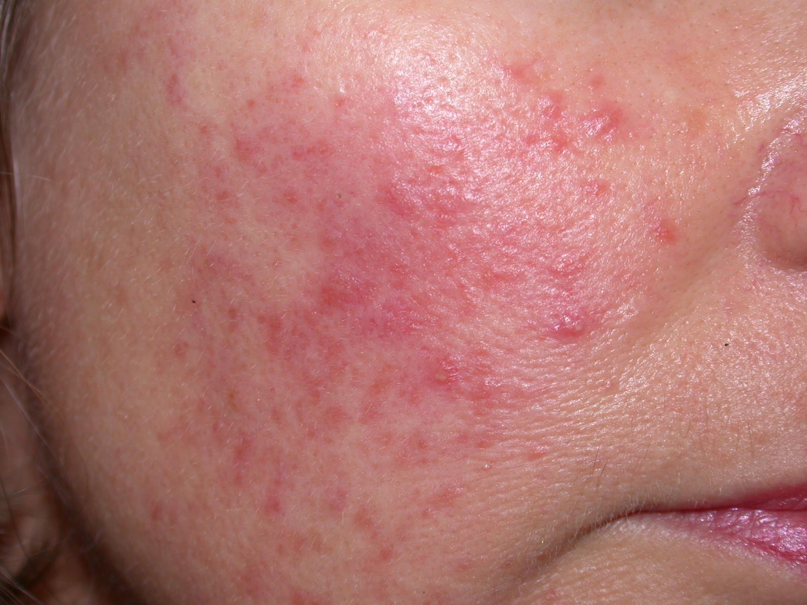 Recurrent blistering facial rashes