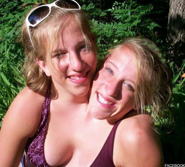 Nude Conjoined Twins Photo - Adult Asbergers