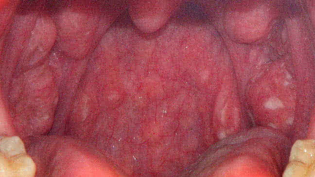 Congo recomended throat strep Adults and