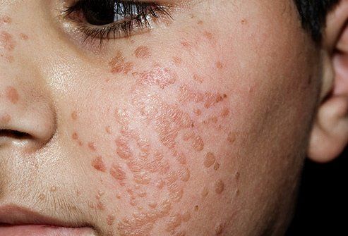best of For facial warts Treatment
