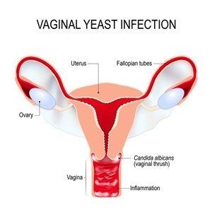 Penis causes burning sensation of vagina