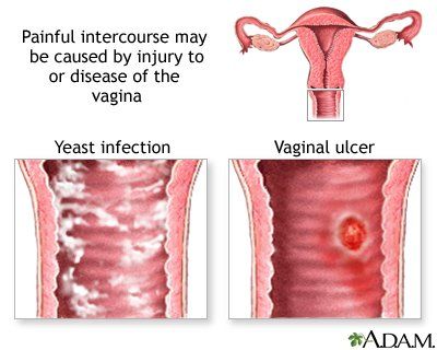 best of Sex after Vaginal infection