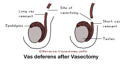 Lord P. S. reccomend Vasectomy sperm leak