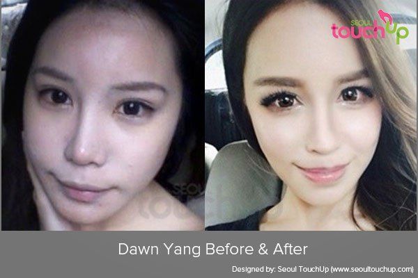 Asian celeb plastic surgery