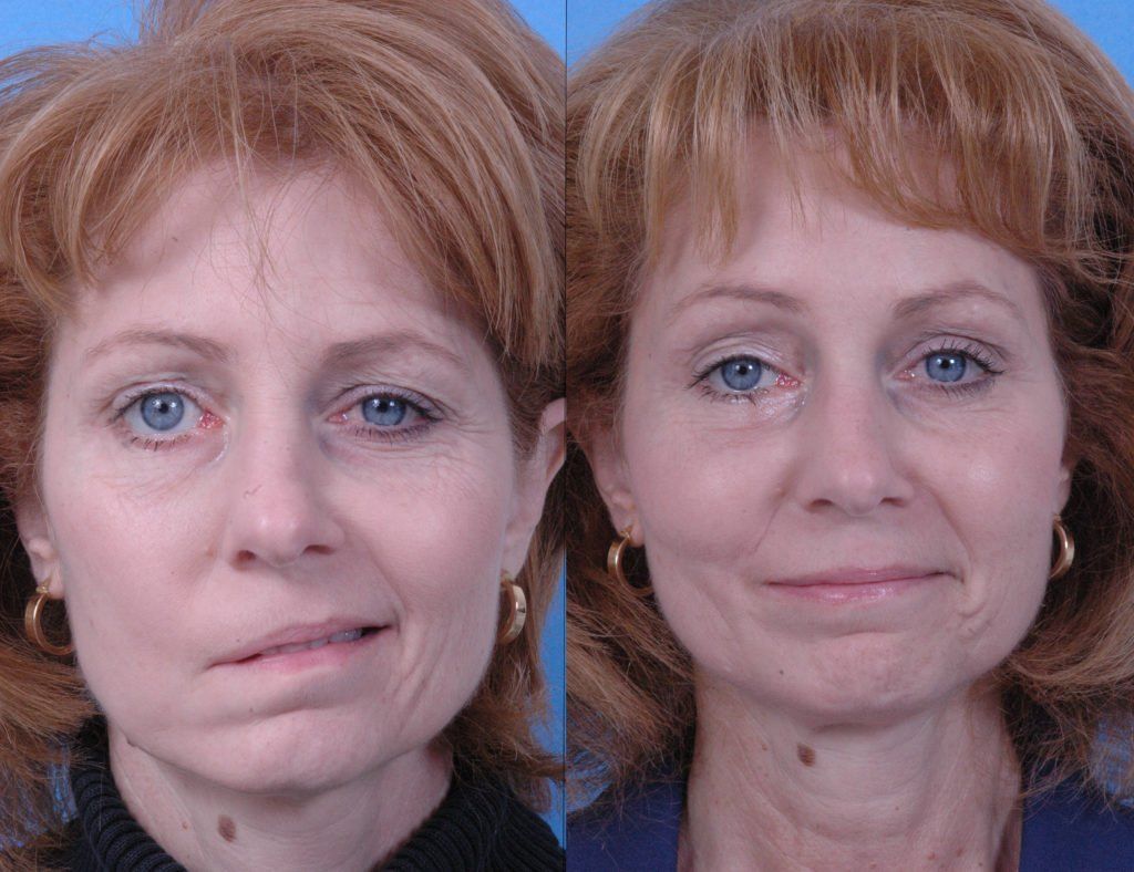 best of Clinic washington paralysis Facial state in