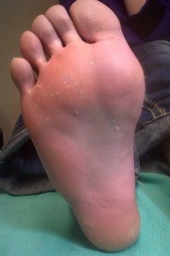 best of Foot bottom of Wart removal