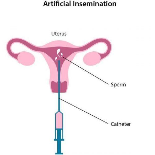 Benz recommendet insemination sperm Artificial