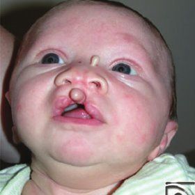 Cupid reccomend Median facial cleft syndrome