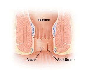 Rosebud reccomend Medical questions anus tear from bowel