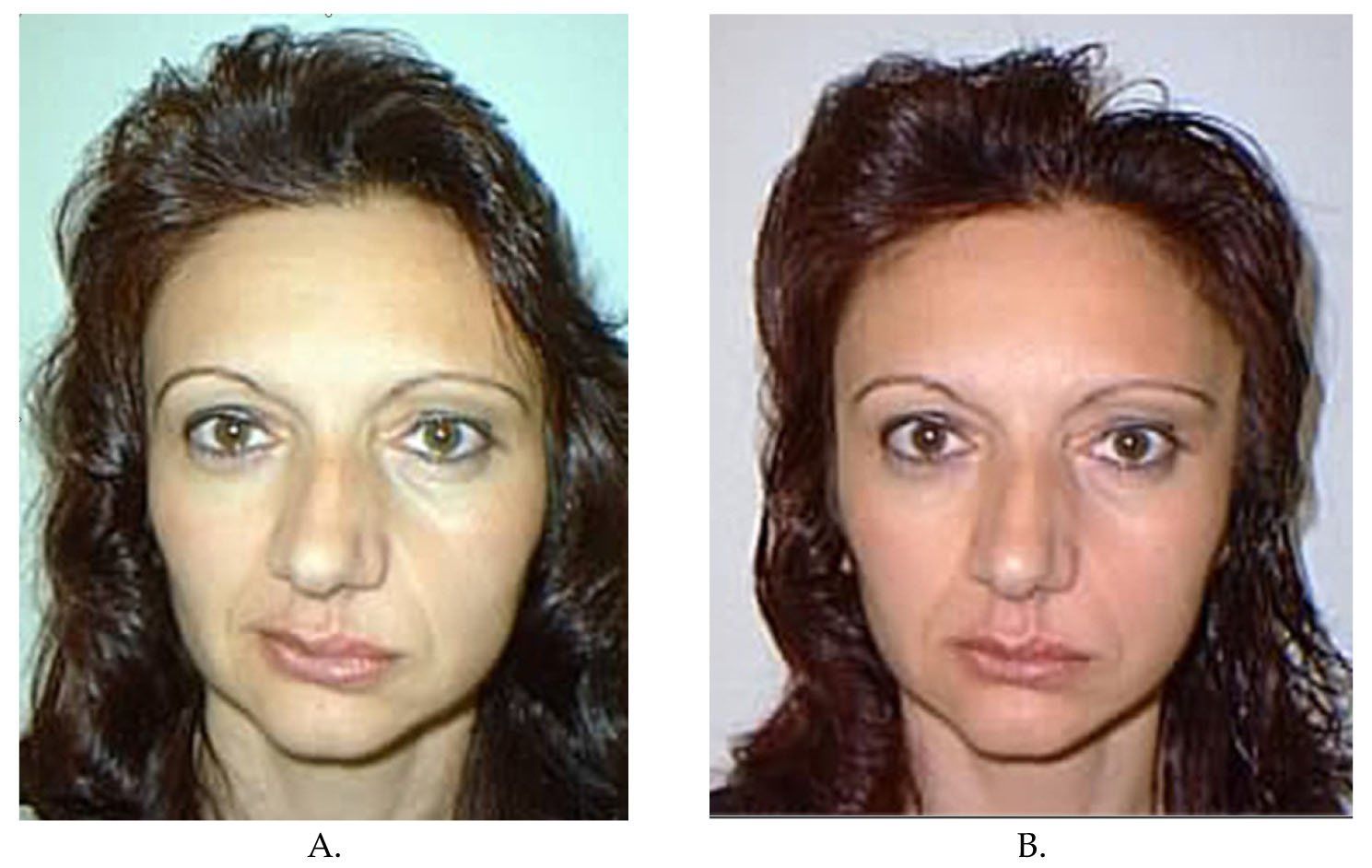 best of Of facial after surgery side cosmetic face flatter One