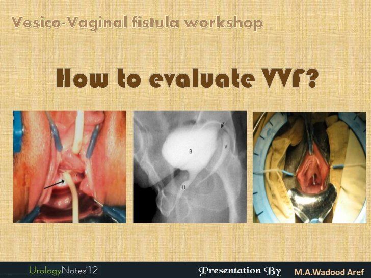 Side Z. reccomend Vesico vaginal fistula pictures