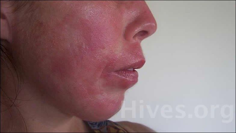 Facial swelling hives