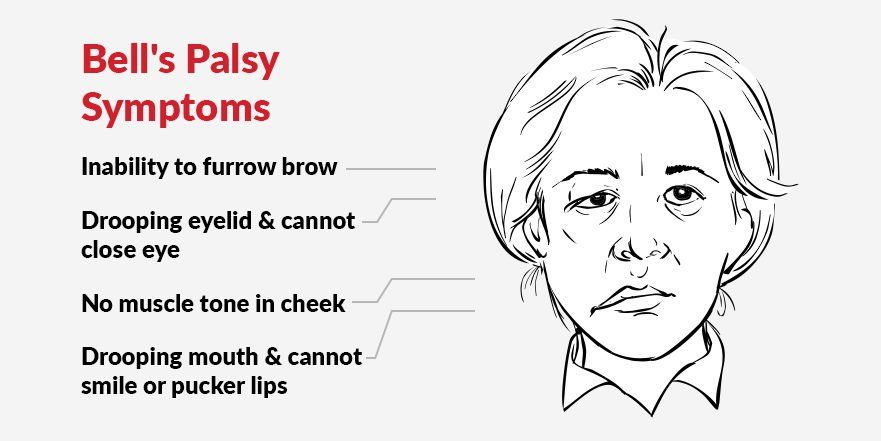 Facial excerizes for droopy eyelids